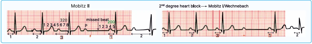 Second-degree Heart Block