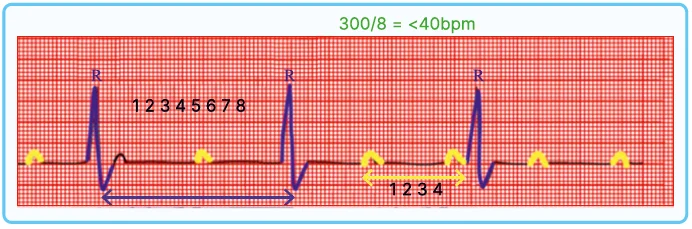 Third-degree heart block/Stokes-Adam syndrome