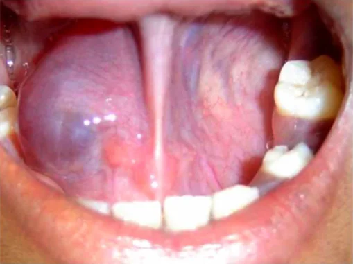 Cysts or Mucocele
