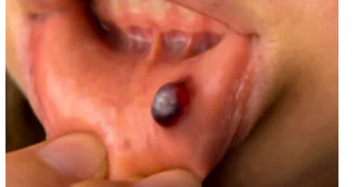 Retention Cysts