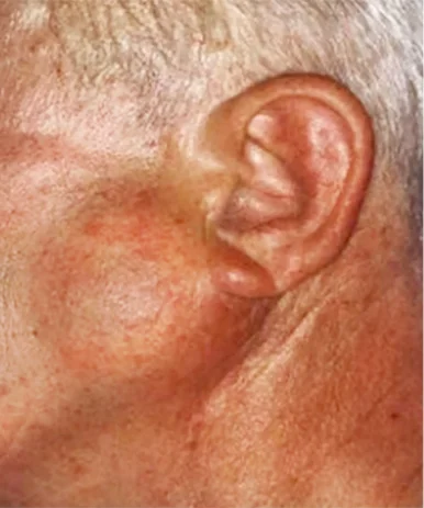 Pleomorphic Adenoma