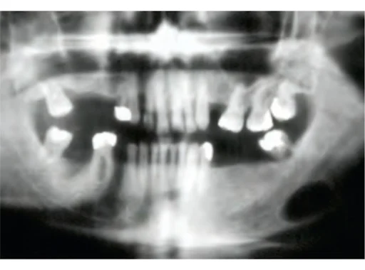 Ectopic / Aberrant Salivary Tissue