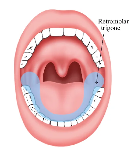 Retromolar Trigone