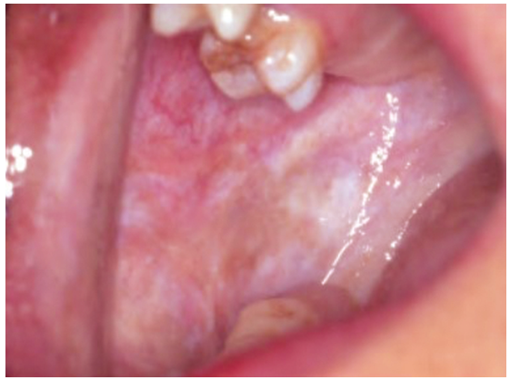 Oral Submucous Fibrosis