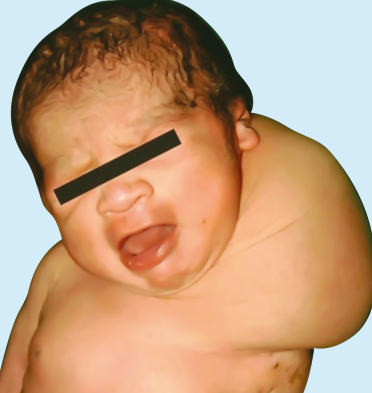 Cystic Hygroma (Lymphangioma)