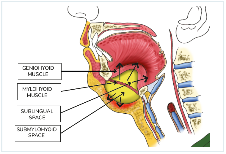 Ludwig's Angina