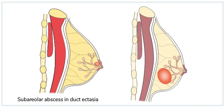 Mastitis and Breast Abscess