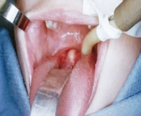 Lingual Thyroid