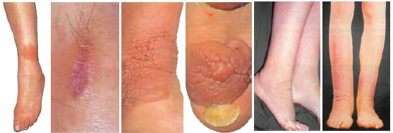 Pretibial Myxedema