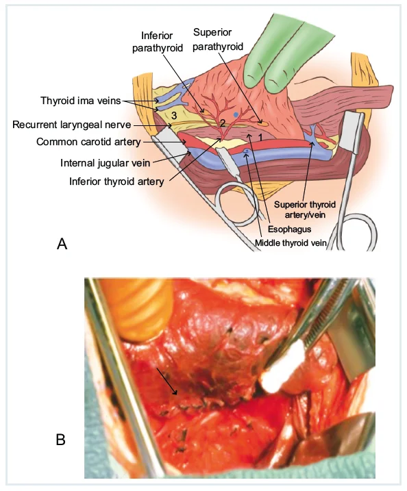 Potential Sites for Recurrent Laryngeal Nerve Injury