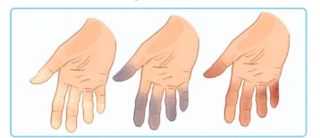 mechanism of the Raynaud phenomenon
