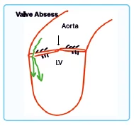 echocardiographic findings in IE progression