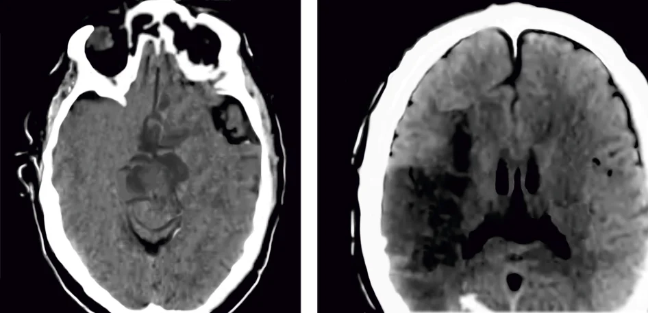 radiological findings in acute ischemic stroke