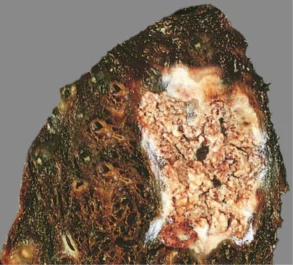 caseous necrosis