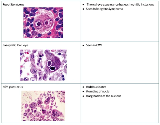 types of multinucleated giant cells