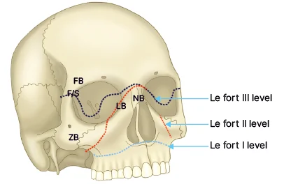 classification of midface fractures.