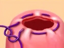 purse-string suture