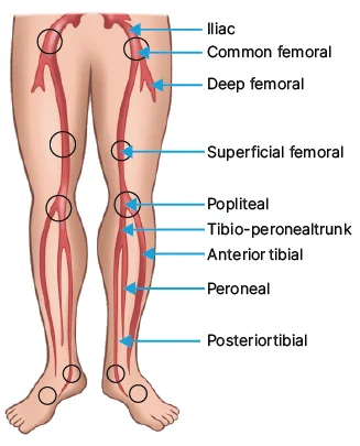 peripheral arterial occlusion