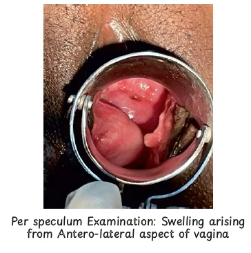 site of a Gartner's cyst
