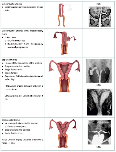 Types of Müllerian duct anomalies 2