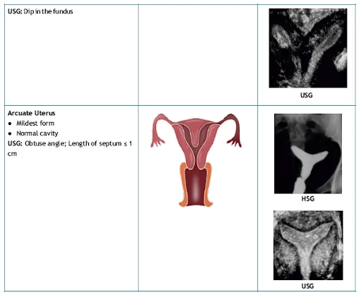 Types of Müllerian duct anomalies