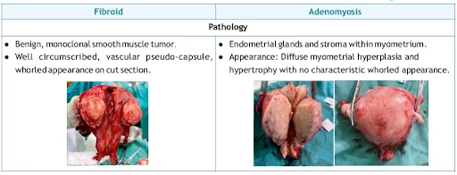 difference in pathology of fibroid and adenomysis