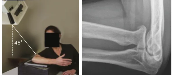 Coyle's view of the elbow