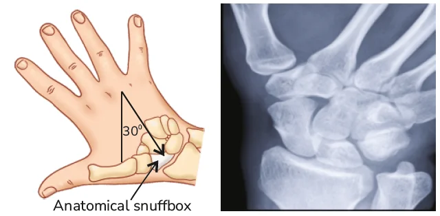 Scaphoid View in wrist radiography