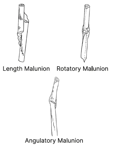 Types of Malunion