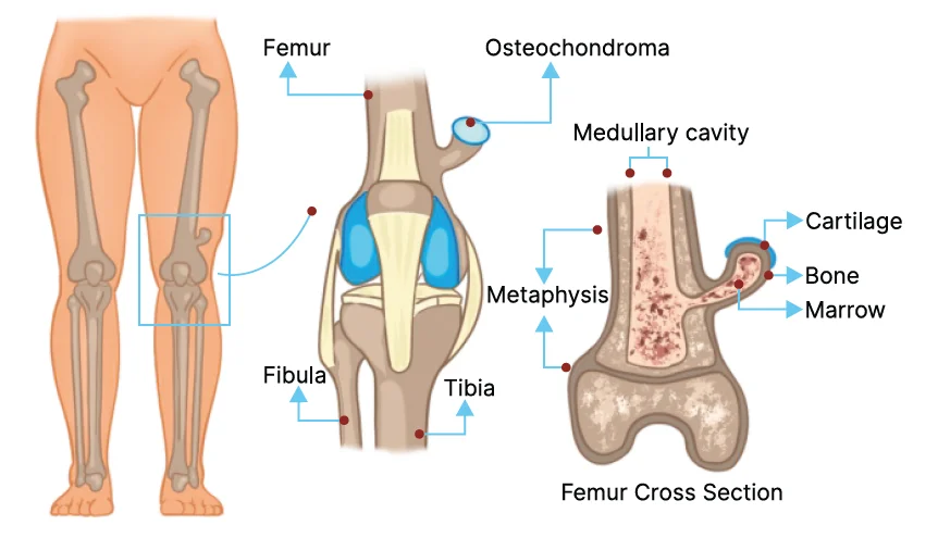 Clinical Presentations of Osteochondroma