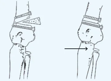 Osteotomy