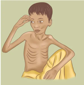 Severely malnourished without
oedema - Marasmus
