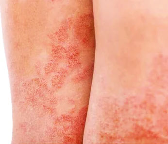 Flaky paint dermatosis