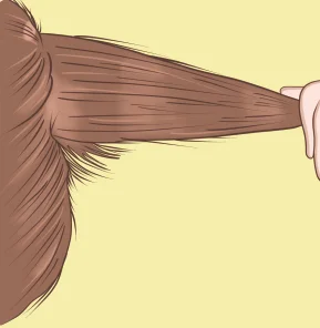 Flag sign: Alternate band of pigmented and
hypopigmented hairs
