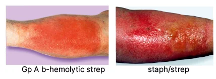 difference between erysipelas and cellulitis