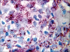 Bacteriological Index (BI) 1