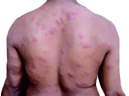 Type 2 reaction
