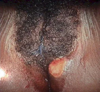 genital ulcer in primary stage of syphilis