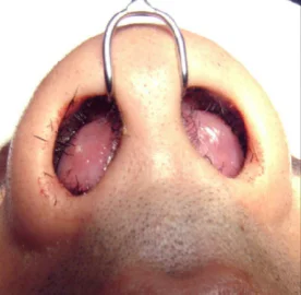 Septal Abscess and Septal Hematoma
