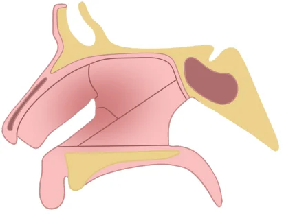 Jarjaway fracture (Class 2) - Direction of fracture - Horizontal