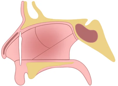 Chevallet fracture (Class 1) - Direction of fracture - Vertical