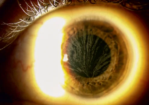 Vortex Keratopathy 2