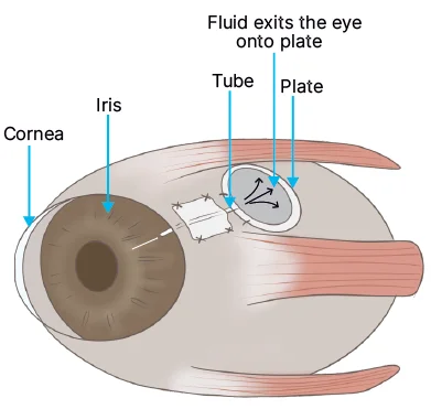 surgical procedure for glaucoma