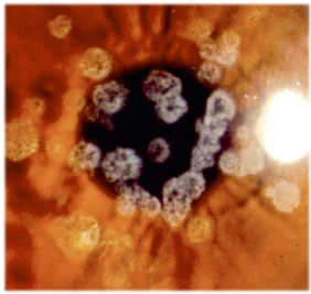 granular dystrophy