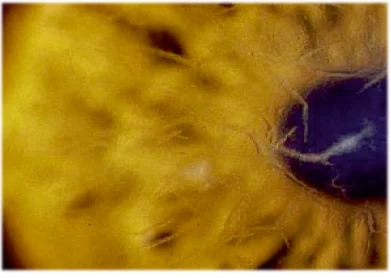 lattice dystrophy
