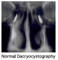 dacryocystography