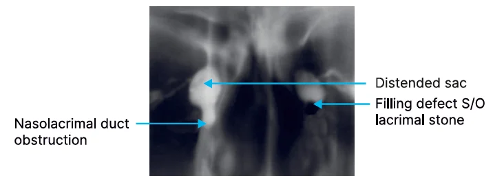 radiological findings of mucocele and dacryolithiasis on dacryocystography