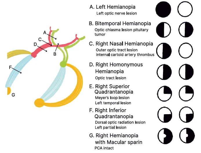 lesions of the visual pathway