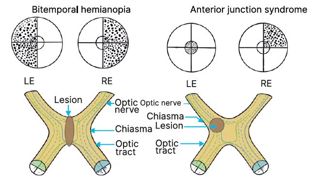 lesions near the junction of the chiasma