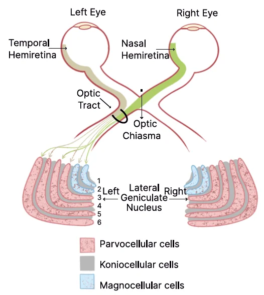 Lateral Geniculate Body (LGB) lesions